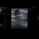 Fibroadenoma of breast: US - Ultrasound